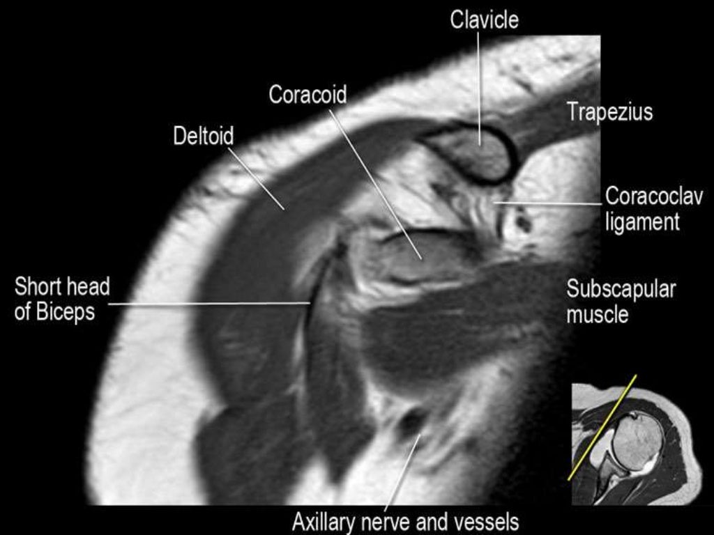 MRI of Shoulder anatomy
