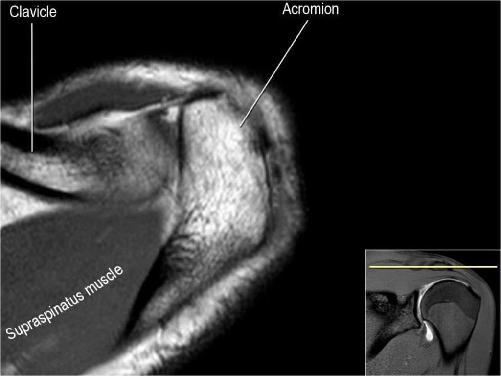 MRI of Shoulder anatomy