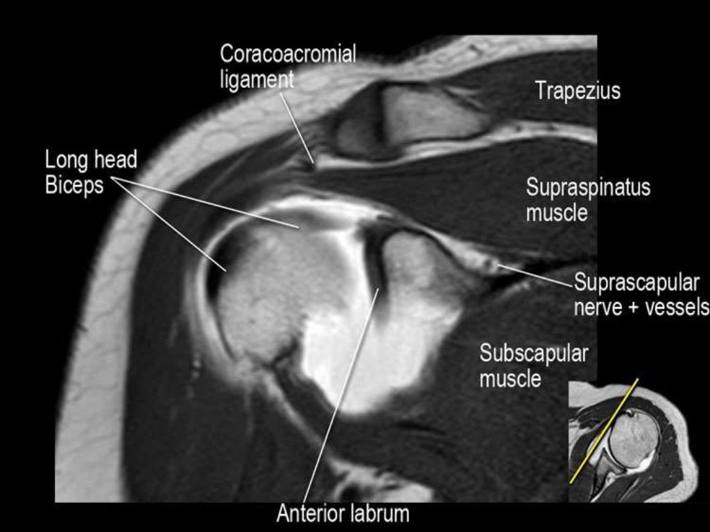 MRI of Shoulder anatomy