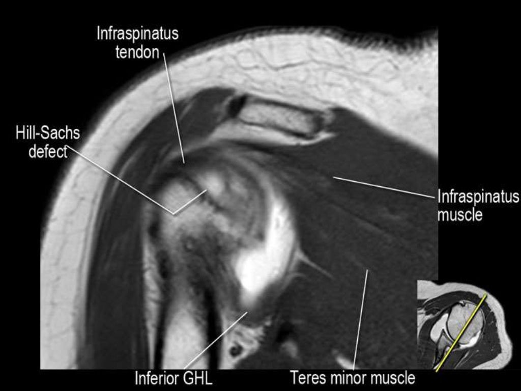 MRI of Shoulder anatomy