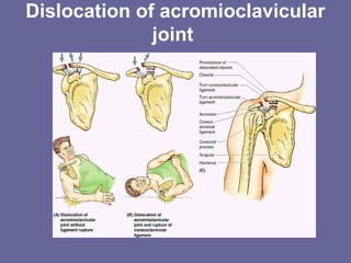 Dislocation of acromioclavicular
joint
 