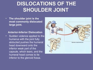 DISLOCATIONS OF THE
SHOULDER JOINT
• The shoulder joint is the
most commonly dislocated
large joint.
Anterior-Inferior Dislocation
• Sudden violence applied to the
humerus with the joint fully
abducted pushes the humeral
head downward onto the
inferior weak part of the
capsule, which tears, and the
humeral head comes to lie
inferior to the glenoid fossa.
 