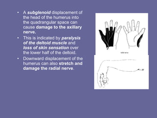 • A subglenoid displacement of
the head of the humerus into
the quadrangular space can
cause damage to the axillary
nerve.
• This is indicated by paralysis
of the deltoid muscle and
loss of skin sensation over
the lower half of the deltoid.
• Downward displacement of the
humerus can also stretch and
damage the radial nerve.
 