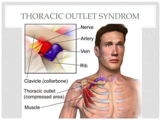 THORACIC OUTLET SYNDROM
 