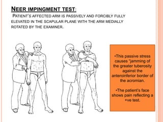 NEER IMPINGMENT TEST:
PATIENT’S AFFECTED ARM IS PASSIVELY AND FORCIBLY FULLY
ELEVATED IN THE SCAPULAR PLANE WITH THE ARM MEDIALLY
ROTATED BY THE EXAMINER.
•This passive stress
causes “jamming of
the greater tuberosity
against the
anteroinferior border of
the acromian.
•The patient’s face
shows pain reflecting a
+ve test.
 