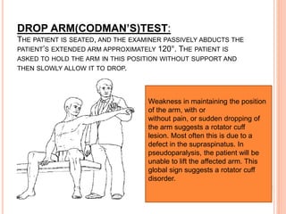 DROP ARM(CODMAN’S)TEST:
THE PATIENT IS SEATED, AND THE EXAMINER PASSIVELY ABDUCTS THE
PATIENT’S EXTENDED ARM APPROXIMATELY 120°. THE PATIENT IS
ASKED TO HOLD THE ARM IN THIS POSITION WITHOUT SUPPORT AND
THEN SLOWLY ALLOW IT TO DROP.
Weakness in maintaining the position
of the arm, with or
without pain, or sudden dropping of
the arm suggests a rotator cuff
lesion. Most often this is due to a
defect in the supraspinatus. In
pseudoparalysis, the patient will be
unable to lift the affected arm. This
global sign suggests a rotator cuff
disorder.
 