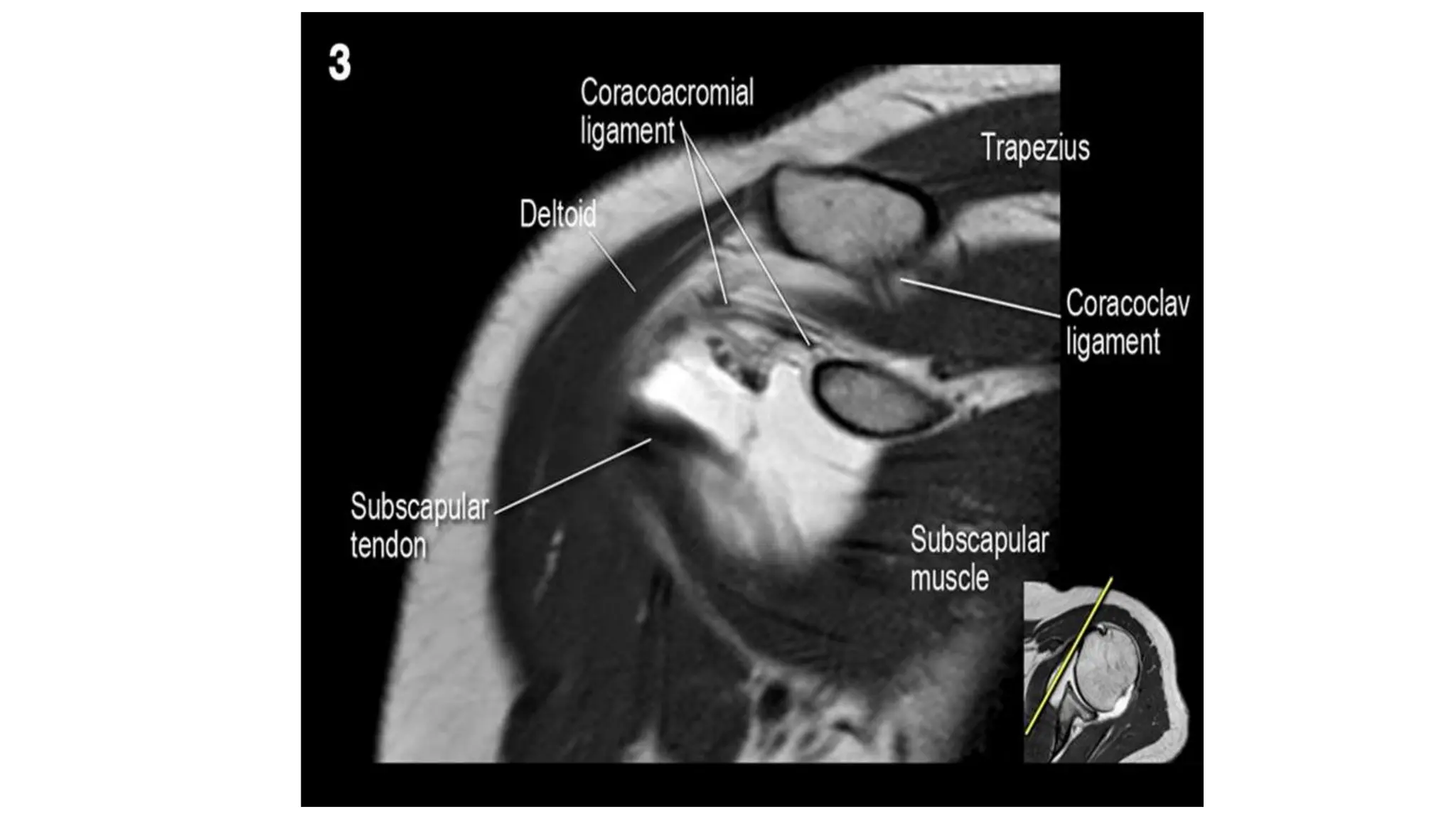 Radiological anatomy of SHOULDER joints | PPTX
