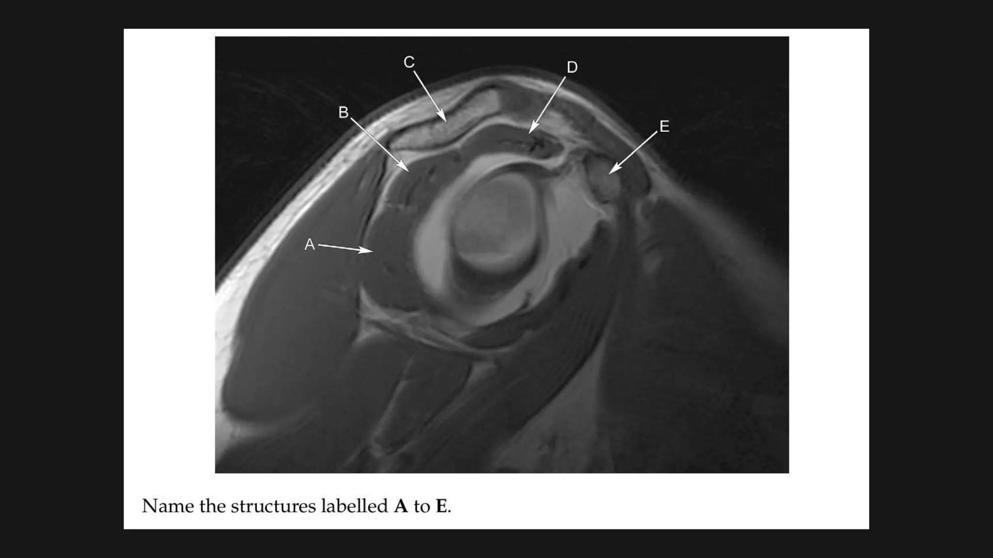 Radiological anatomy of SHOULDER joints | PPTX