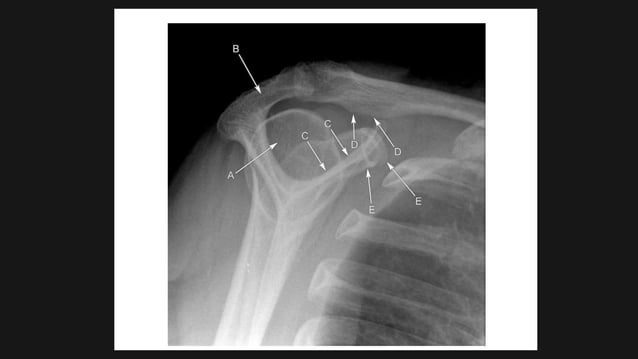 Radiological anatomy of SHOULDER joints | PPTX