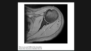 Shoulder Geode Radiological anatomy of SHOULDER joints | PPTX