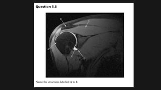 Shoulder Geode Radiological anatomy of SHOULDER joints | PPTX