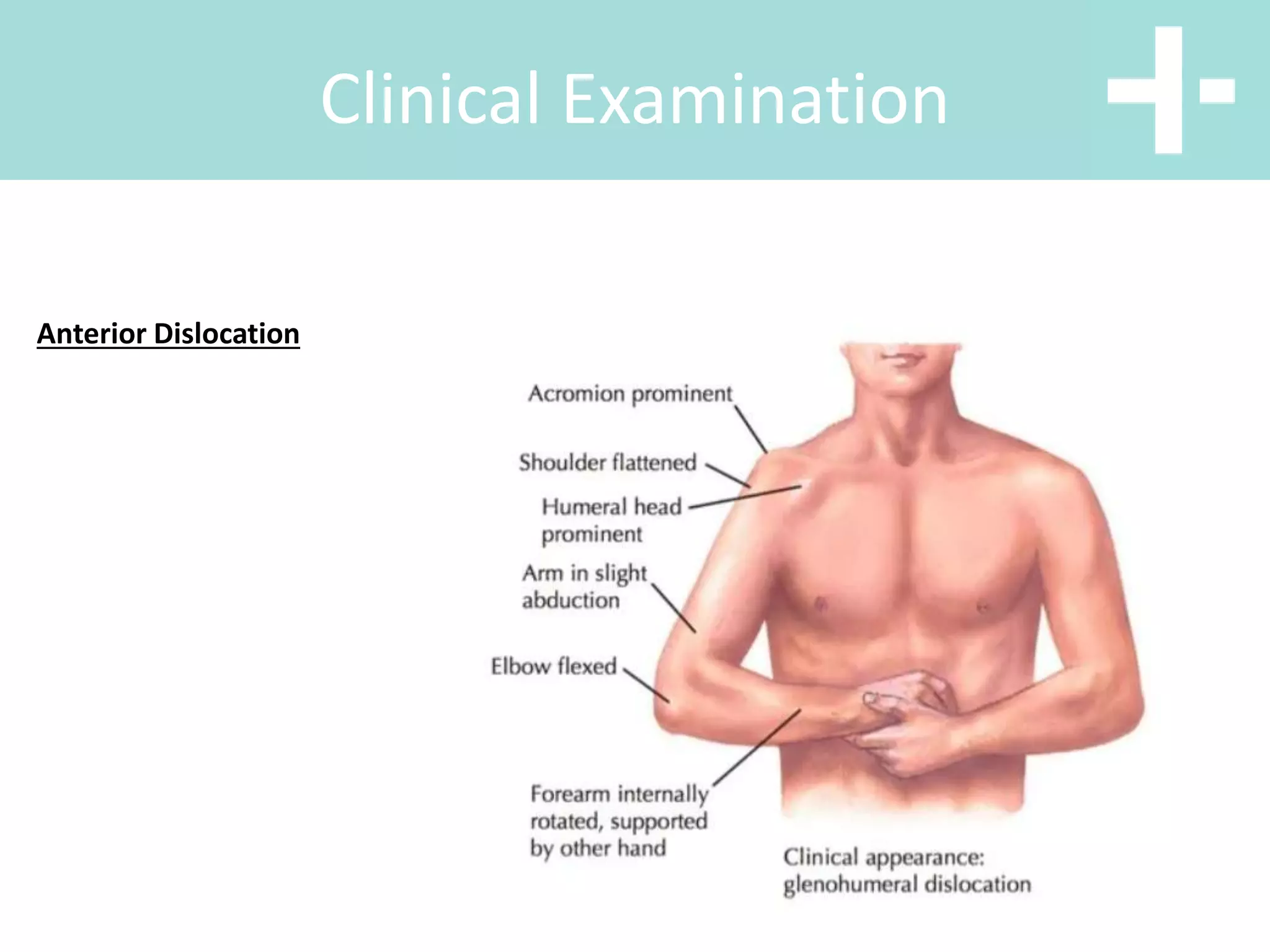 Clinical Examination
Anterior Dislocation
 