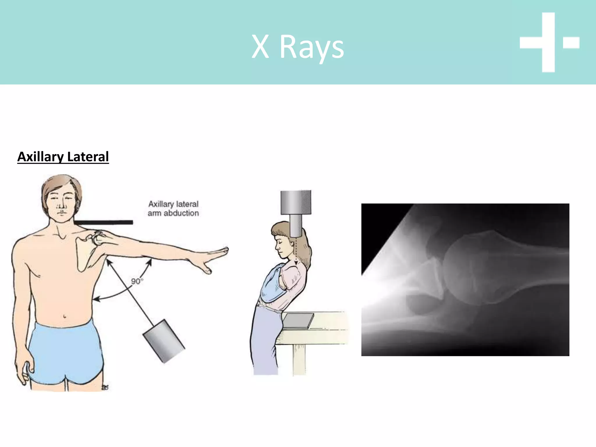 X Rays
Axillary Lateral
 