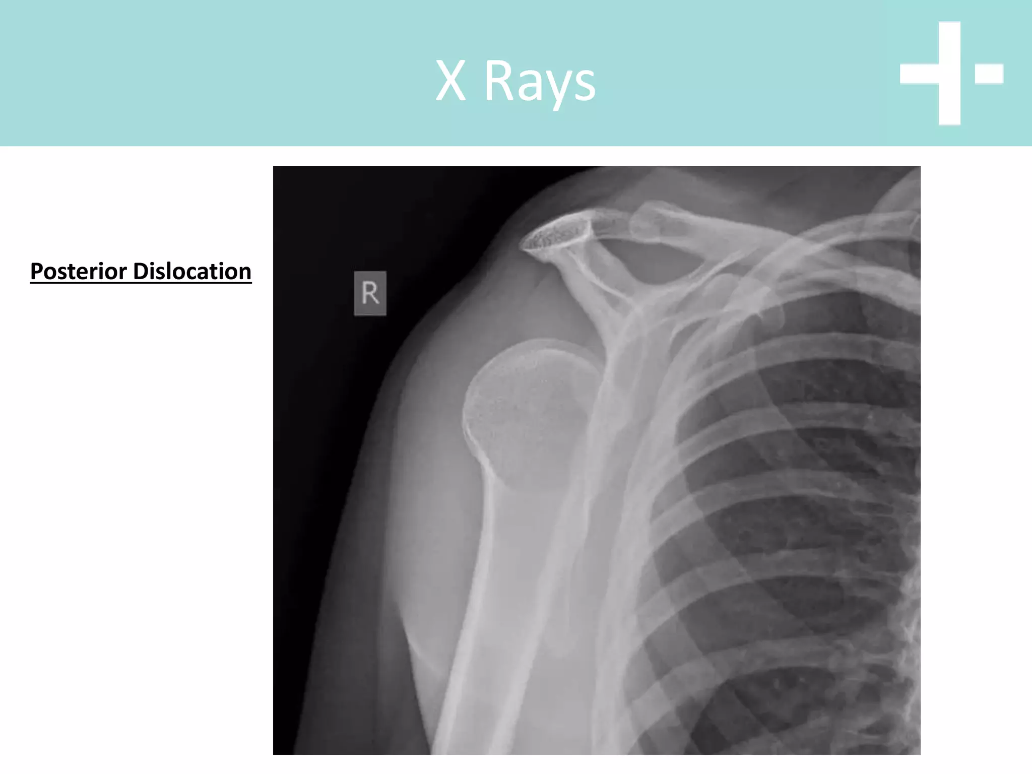 X Rays
Posterior Dislocation
 