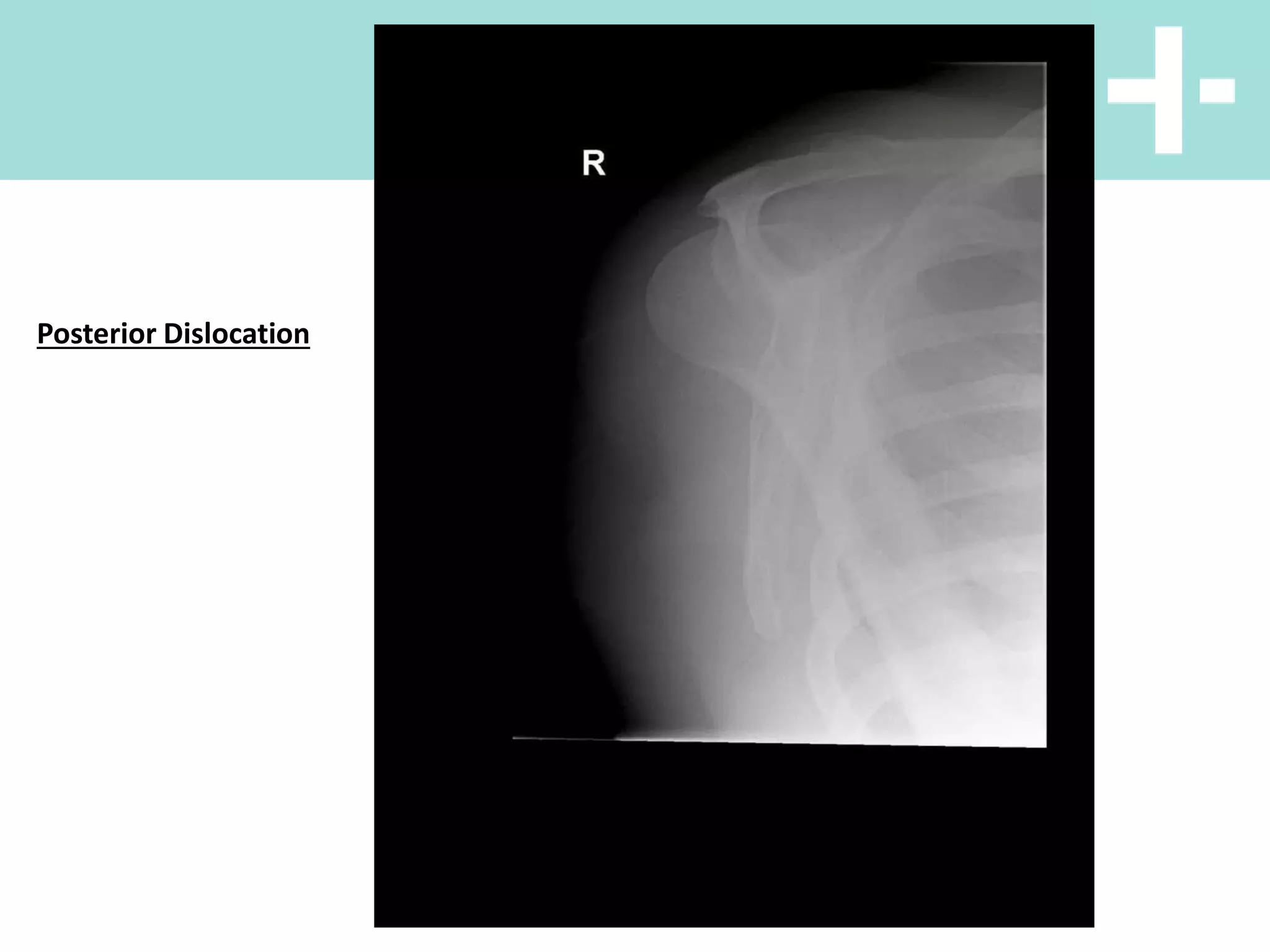 X Rays
Posterior Dislocation
 
