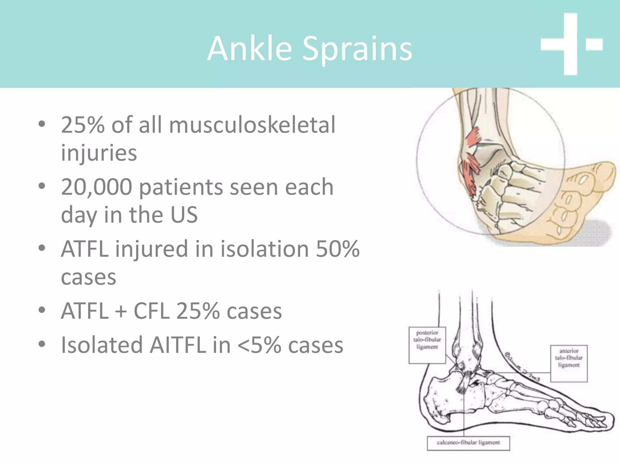 • 25% of all musculoskeletal
injuries
• 20,000 patients seen each
day in the US
• ATFL injured in isolation 50%
cases
• ATFL + CFL 25% cases
• Isolated AITFL in <5% cases
Ankle Sprains
 