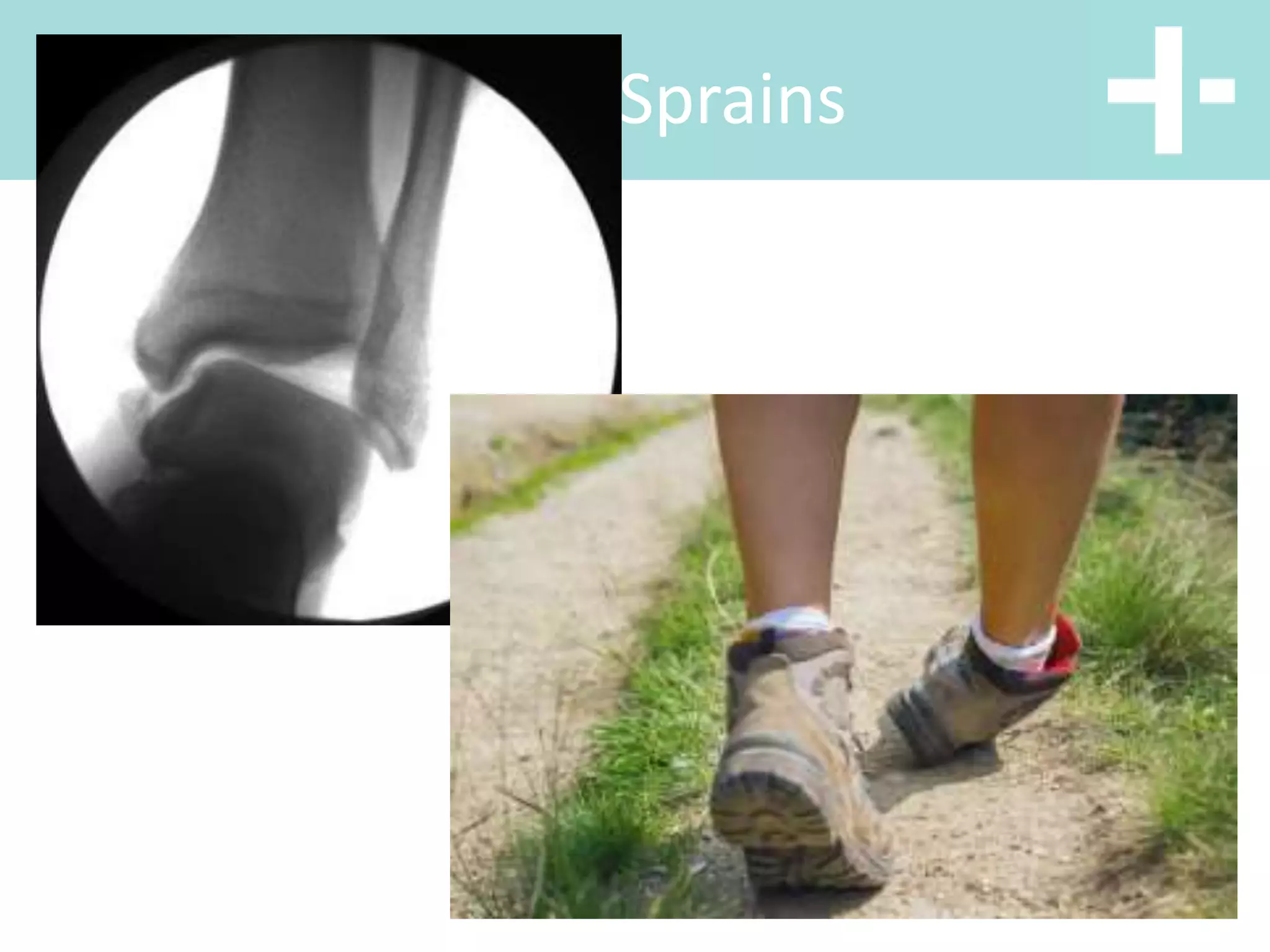 Ankle Sprains
 