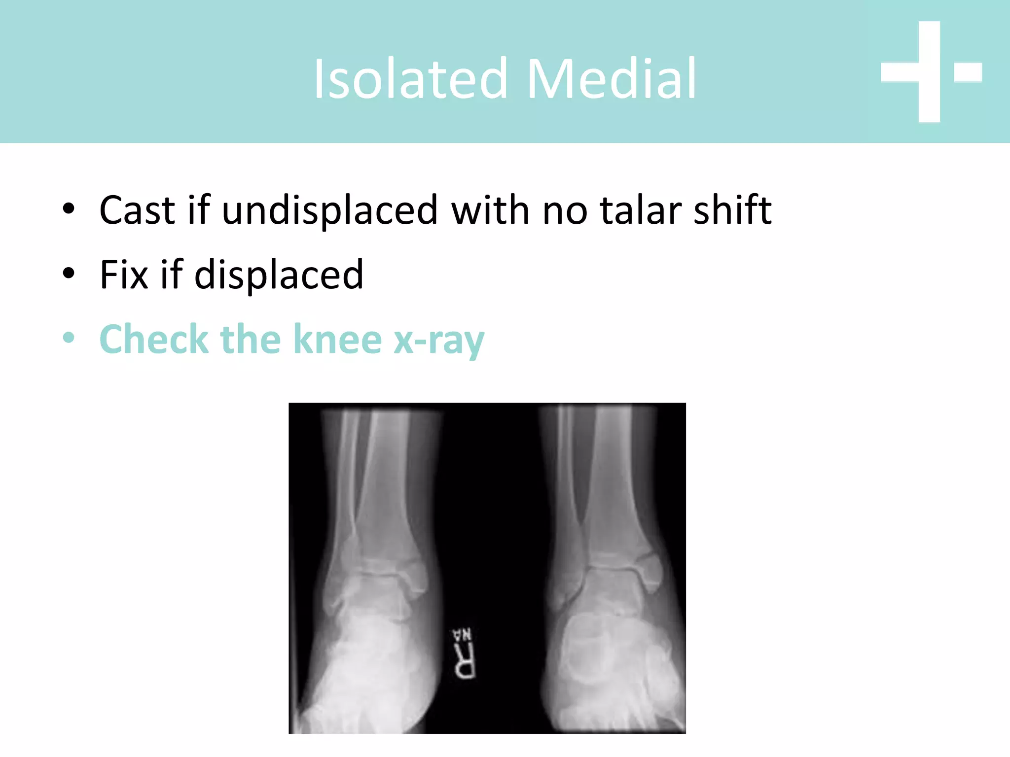 • Cast if undisplaced with no talar shift
• Fix if displaced
• Check the knee x-ray
Isolated Medial
 
