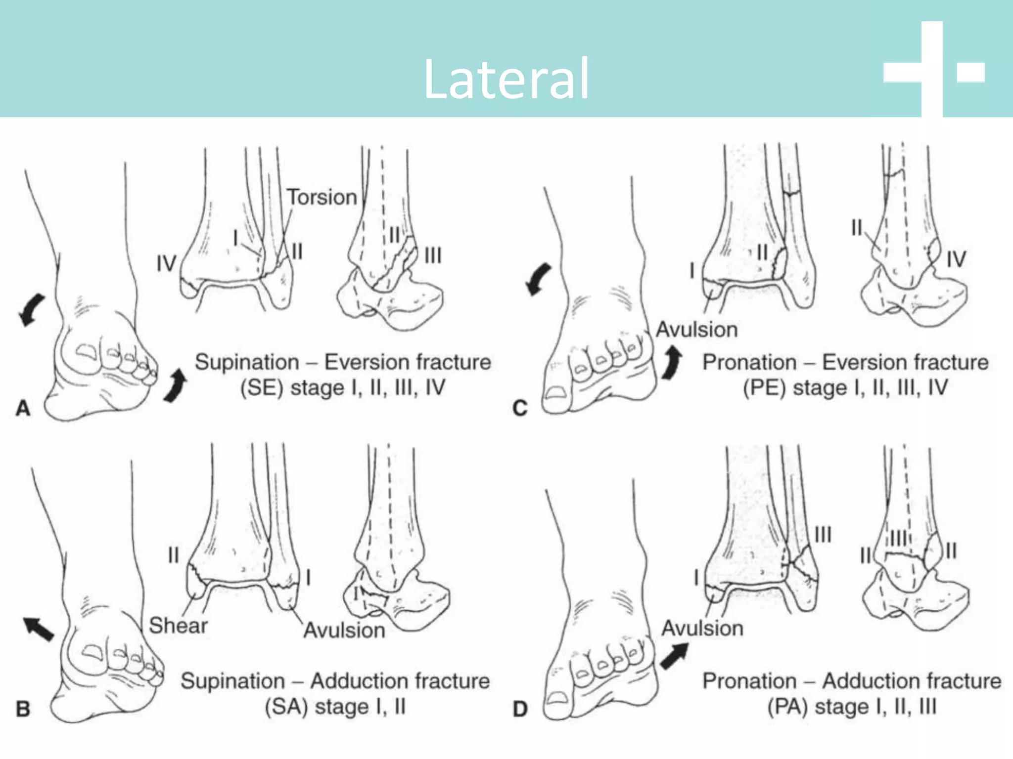 Lateral
 
