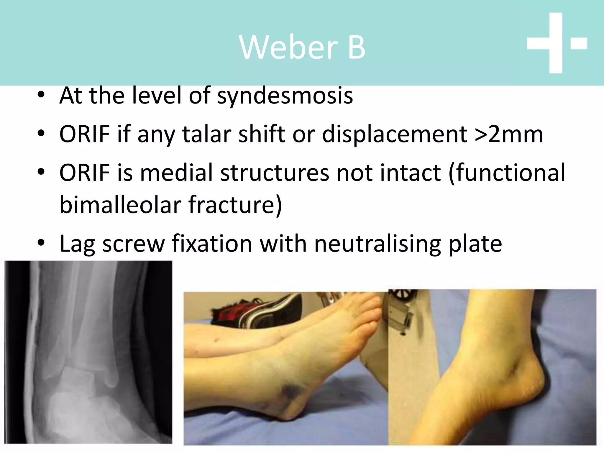 • At the level of syndesmosis
• ORIF if any talar shift or displacement >2mm
• ORIF is medial structures not intact (functional
bimalleolar fracture)
• Lag screw fixation with neutralising plate
Weber B
 