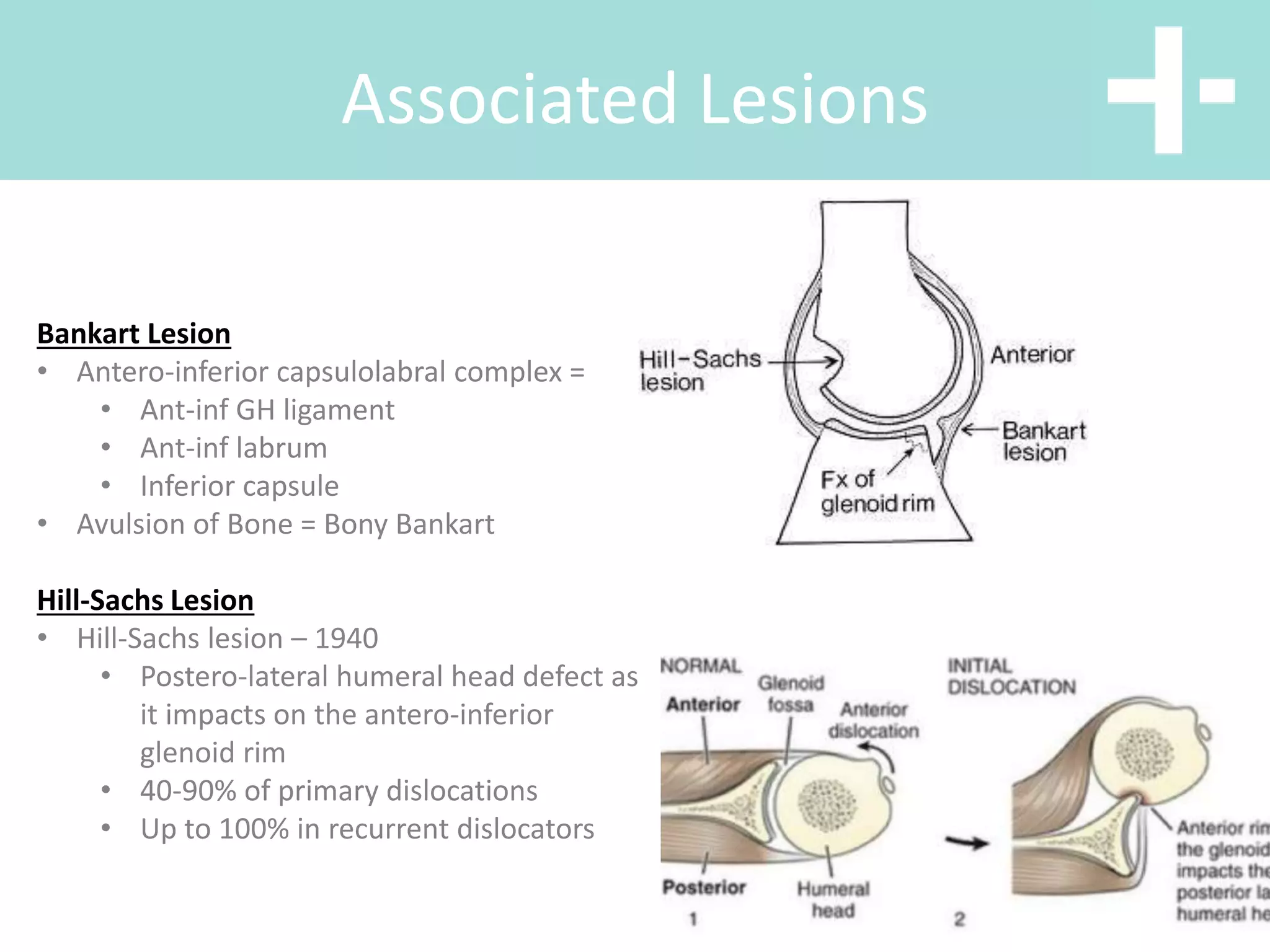 Associated Lesions
Bankart Lesion
• Antero-inferior capsulolabral complex =
• Ant-inf GH ligament
• Ant-inf labrum
• Inferior capsule
• Avulsion of Bone = Bony Bankart
Hill-Sachs Lesion
• Hill-Sachs lesion – 1940
• Postero-lateral humeral head defect as
it impacts on the antero-inferior
glenoid rim
• 40-90% of primary dislocations
• Up to 100% in recurrent dislocators
 