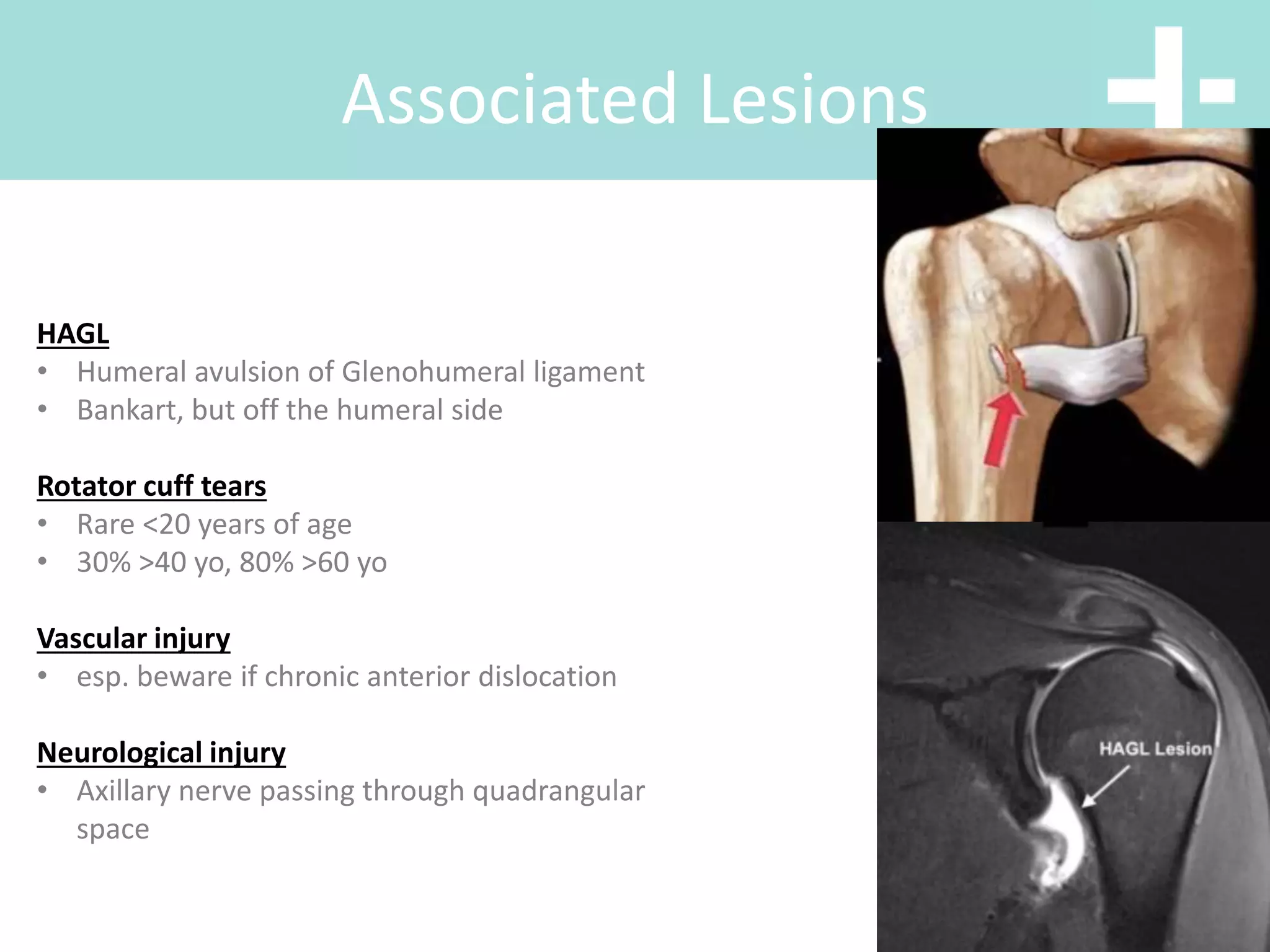 Associated Lesions
HAGL
• Humeral avulsion of Glenohumeral ligament
• Bankart, but off the humeral side
Rotator cuff tears
• Rare <20 years of age
• 30% >40 yo, 80% >60 yo
Vascular injury
• esp. beware if chronic anterior dislocation
Neurological injury
• Axillary nerve passing through quadrangular
space
 
