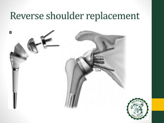 Shoulder arthroplasty - Basic information about shoulder replacement ...