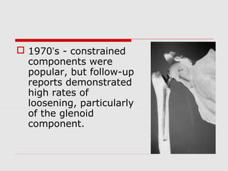  1970’s - constrained
components were
popular, but follow-up
reports demonstrated
high rates of
loosening, particularly
of the glenoid
component.
 