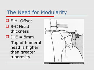 The Need for Modularity
 F-H Offset
 B-C Head
thickness
 D-E = 8mm
Top of humeral
head is higher
than greater
tuberosity
 