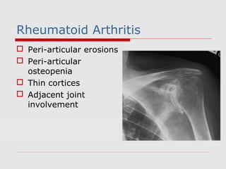 Rheumatoid Arthritis
 Peri-articular erosions
 Peri-articular
osteopenia
 Thin cortices
 Adjacent joint
involvement
 