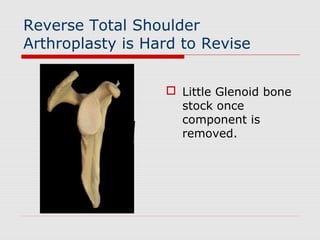 Reverse Total Shoulder
Arthroplasty is Hard to Revise
 Little Glenoid bone
stock once
component is
removed.
 