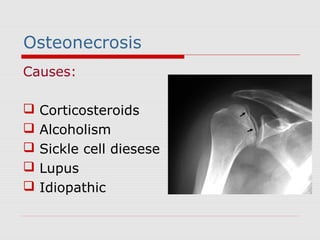 Osteonecrosis
Causes:
 Corticosteroids
 Alcoholism
 Sickle cell diesese
 Lupus
 Idiopathic
 