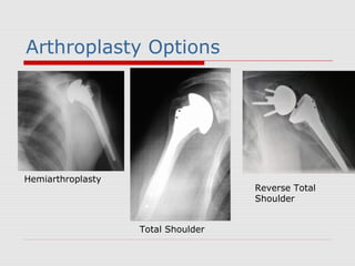 Hemiarthroplasty
Total Shoulder
Reverse Total
Shoulder
Arthroplasty Options
 