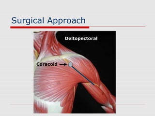 Surgical Approach
Deltopectoral
Coracoid
 
