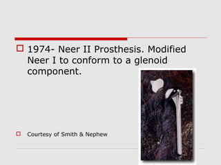  1974- Neer II Prosthesis. Modified
Neer I to conform to a glenoid
component.
 Courtesy of Smith & Nephew
 