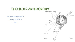 SHOULDER ARTHROSCOPY
DR. MUHAMMAD JAWAD
PGT ORTHOPEDICS
SHL
 