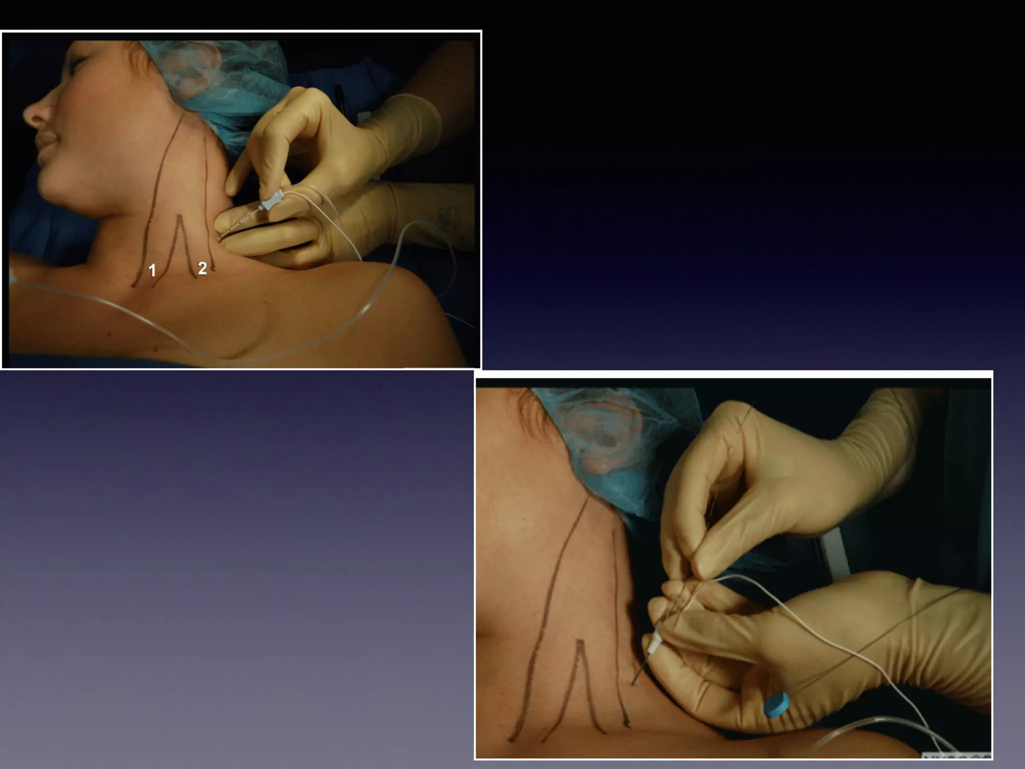 Shoulder block tutorial 2014 | PPT | Free Download