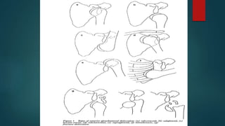 Tow Dislocation SHOULDER DISLOCATION-1.pptx