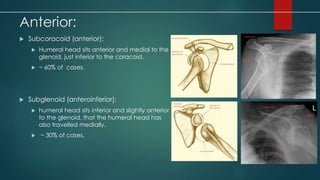 Anterior: 
 Subcoracoid (anterior): 
 Humeral head sits anterior and medial to the 
glenoid, just inferior to the coracoid. 
 ~ 60% of cases. 
 Subglenoid (anteroinferior): 
 humeral head sits inferior and slightly anterior 
to the glenoid, that the humeral head has 
also travelled medially. 
 ~ 30% of cases. 
 
