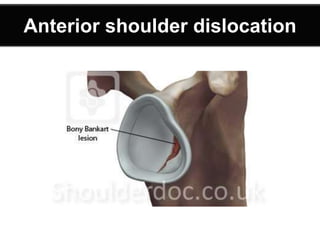 Anterior shoulder dislocation
 