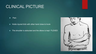CLINICAL PICTURE
 Pain
 Holds injured limb with other hand close to trunk
 The shoulder is abducted and the elbow is kept FLEXED
 