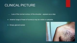 CLINICAL PICTURE
…. Loss of the normal contour of the shoulder - appears as a step
 Anterior bulge of head of humerus may be visible or palpable
 Empty glenoid socket
 