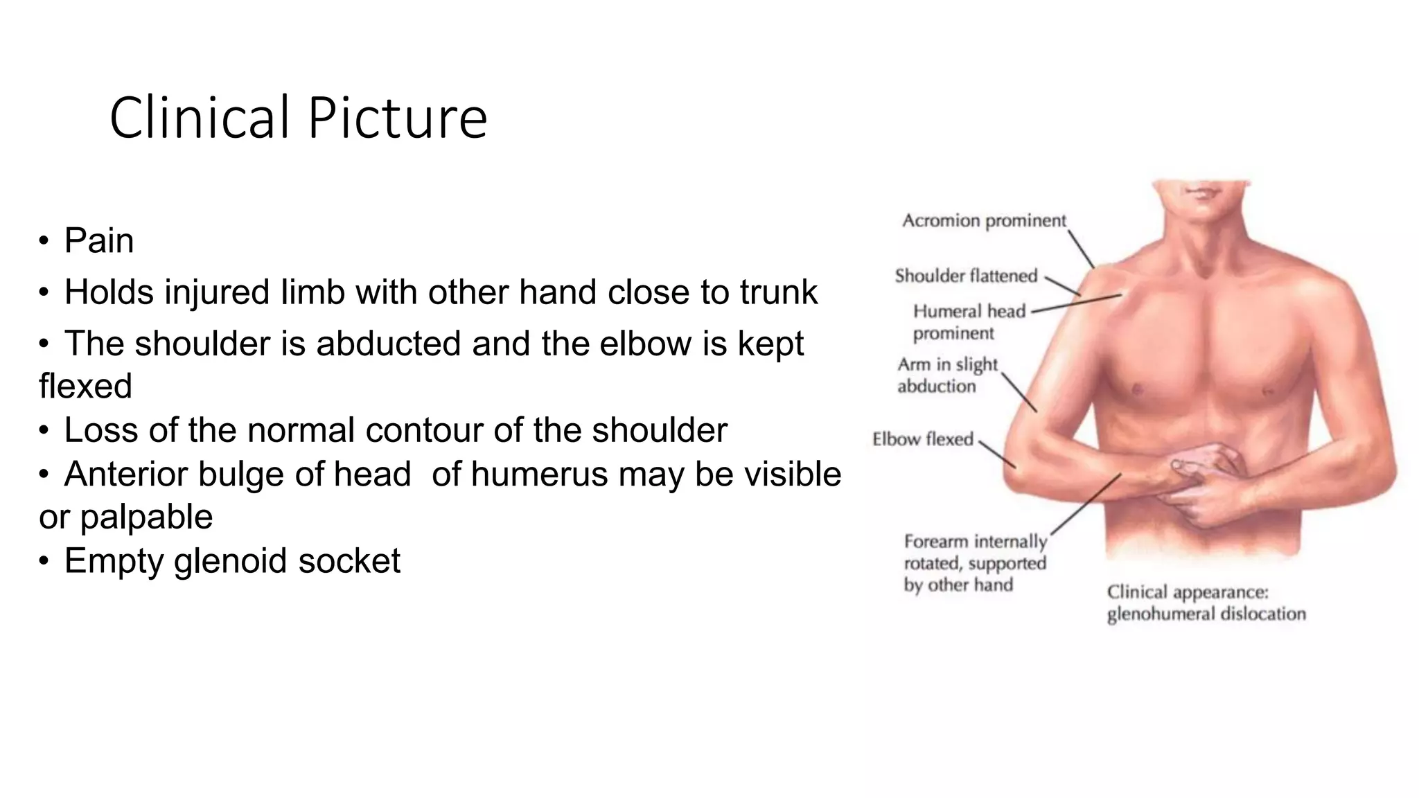 Clinical Picture
• Pain
• Holds injured limb with other hand close to trunk
• The shoulder is abducted and the elbow is kept
flexed
• Loss of the normal contour of the shoulder
• Anterior bulge of head of humerus may be visible
or palpable
• Empty glenoid socket
 