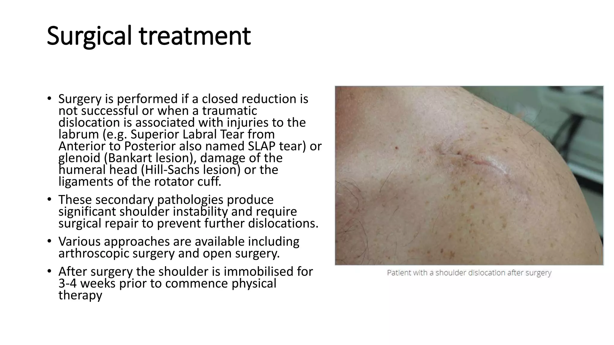 Surgical treatment
• Surgery is performed if a closed reduction is
not successful or when a traumatic
dislocation is associated with injuries to the
labrum (e.g. Superior Labral Tear from
Anterior to Posterior also named SLAP tear) or
glenoid (Bankart lesion), damage of the
humeral head (Hill-Sachs lesion) or the
ligaments of the rotator cuff.
• These secondary pathologies produce
significant shoulder instability and require
surgical repair to prevent further dislocations.
• Various approaches are available including
arthroscopic surgery and open surgery.
• After surgery the shoulder is immobilised for
3-4 weeks prior to commence physical
therapy
 