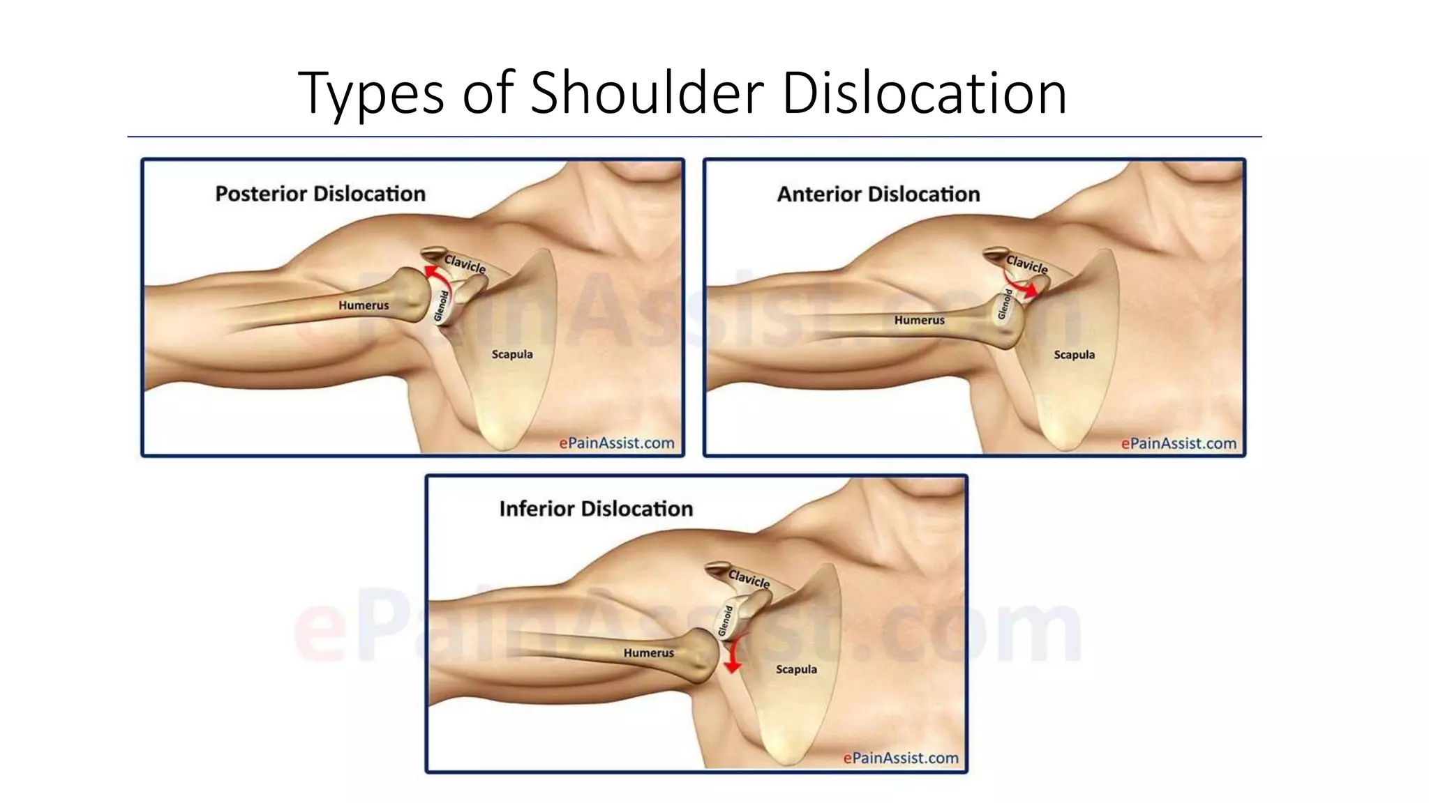 Types of Shoulder Dislocation
 
