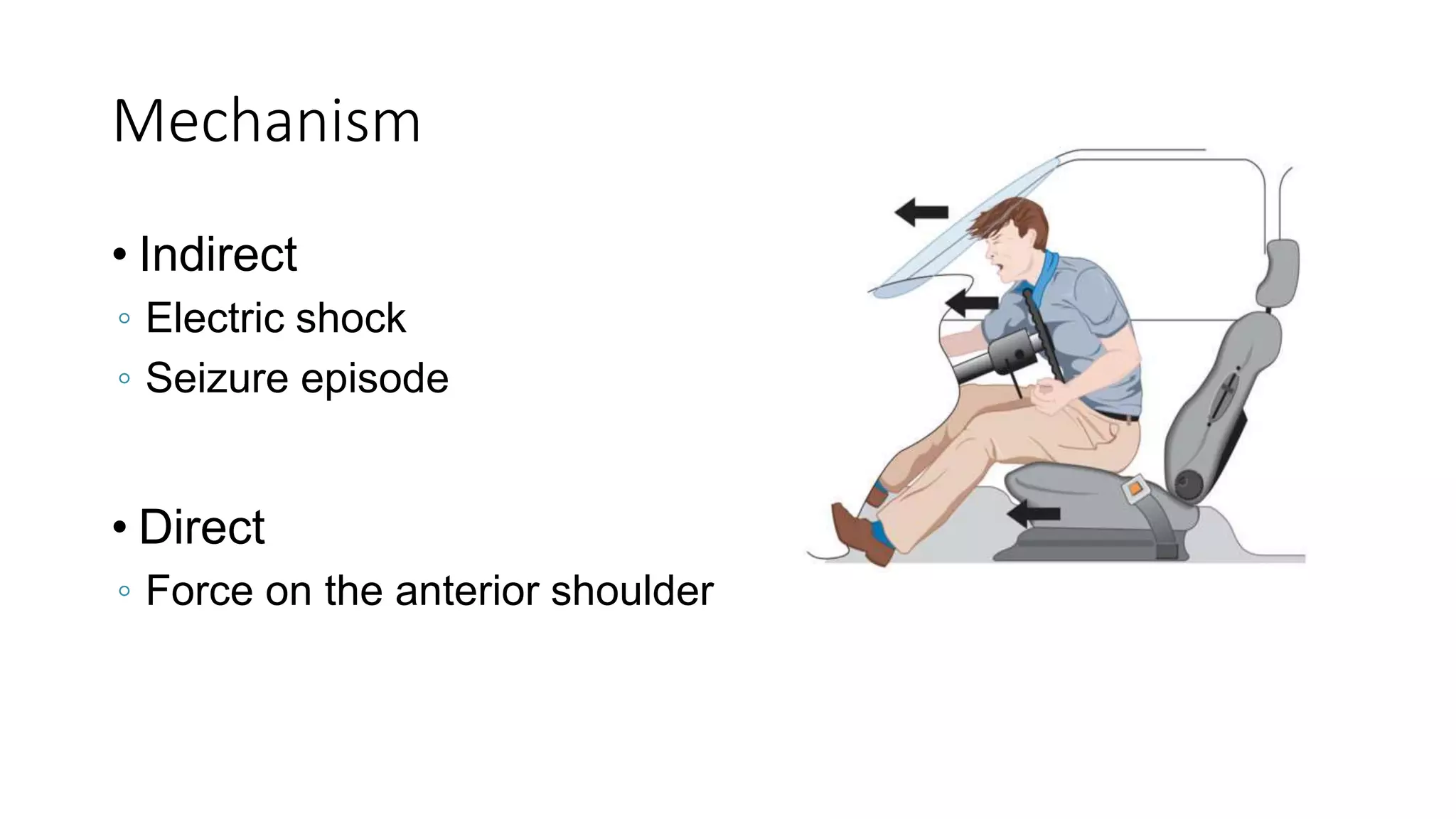 Mechanism
• Indirect
◦ Electric shock
◦ Seizure episode
• Direct
◦ Force on the anterior shoulder
 
