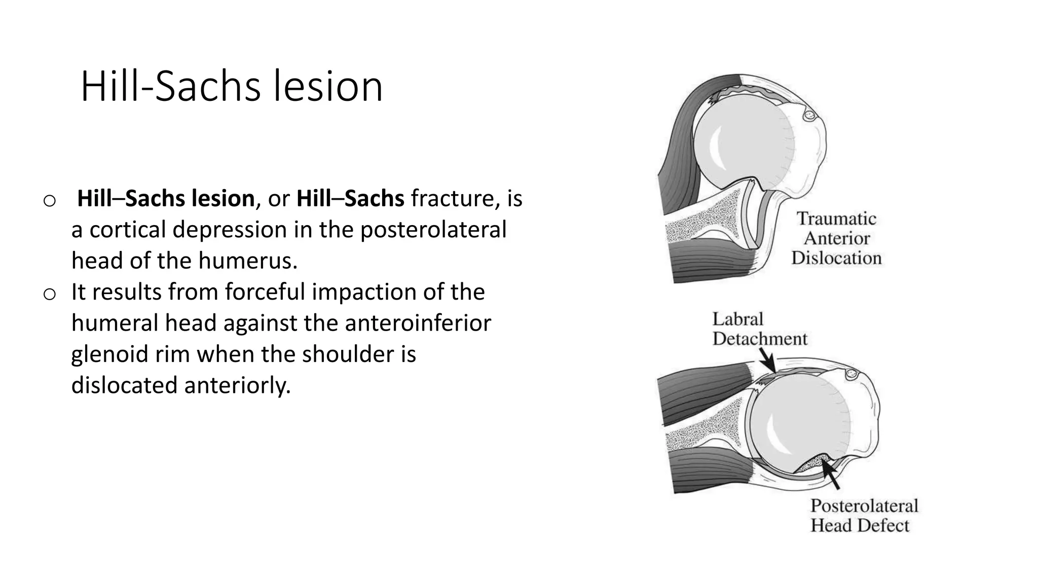 Hill-Sachs lesion
o Hill–Sachs lesion, or Hill–Sachs fracture, is
a cortical depression in the posterolateral
head of the humerus.
o It results from forceful impaction of the
humeral head against the anteroinferior
glenoid rim when the shoulder is
dislocated anteriorly.
 