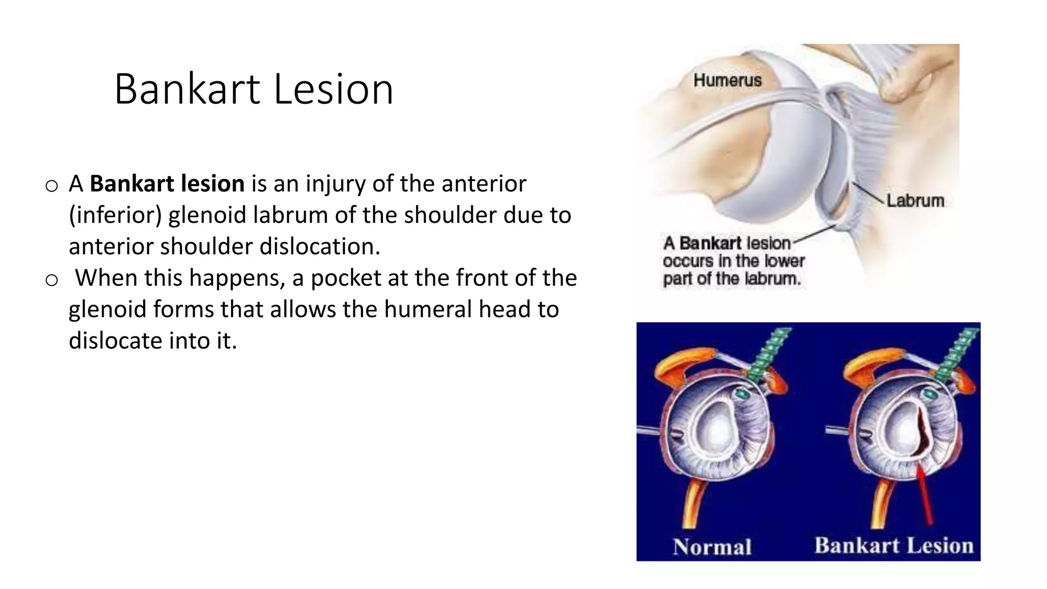 Bankart Lesion
o A Bankart lesion is an injury of the anterior
(inferior) glenoid labrum of the shoulder due to
anterior shoulder dislocation.
o When this happens, a pocket at the front of the
glenoid forms that allows the humeral head to
dislocate into it.
 