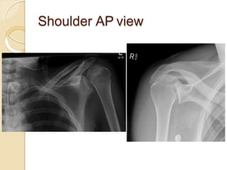 Shoulder AP view
 