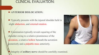 CLINICAL EVALUATION:
 ANTERIOR DISLOCATION:
 Typically presents with the injured shoulder held in
slight abduction, and external rotation.
 Examination typically reveals squaring of the
shoulder owing to a relative prominence of the
acromion, a relative hollow beneath the acromion
posteriorly and a palpable mass anteriorly.
 Integrity of axillary nerve should be carefully examined.
 